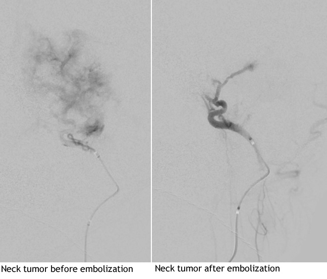 Head and Neck Tumors before and after embolization