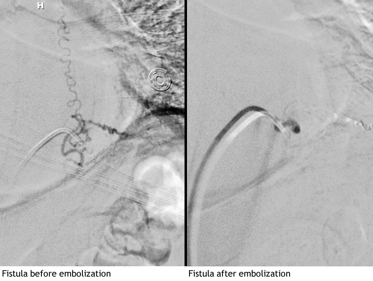 Fistual before and after Emobolization