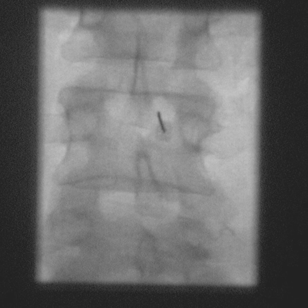 translaminar epidural injection