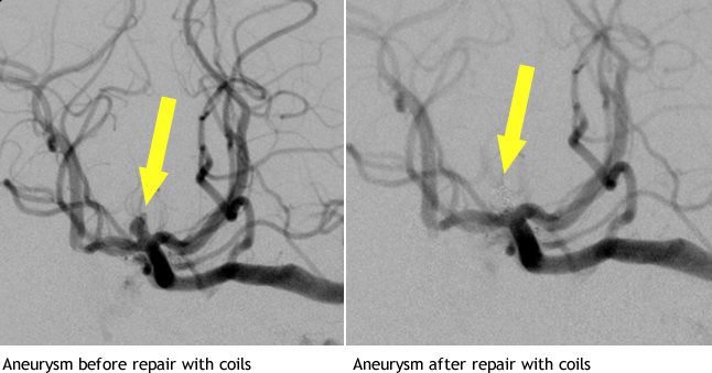 Aneurysm Repair