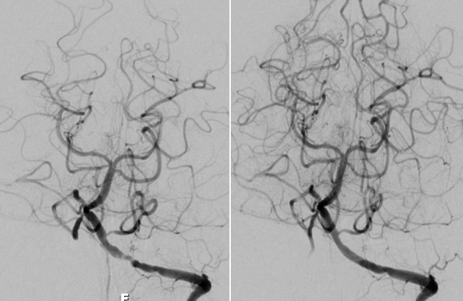 Arterial Stenosis Brain