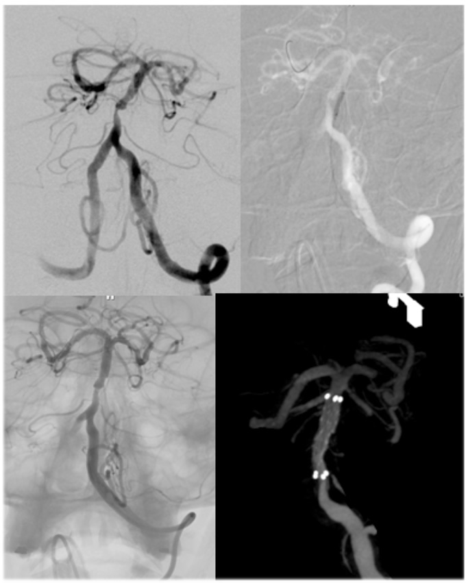 arterial stenosis of the brain