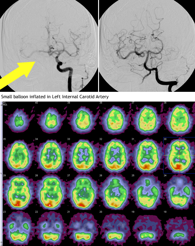 Temporary Balloon Occlusion with small balloon inflated in left interal carotid artery