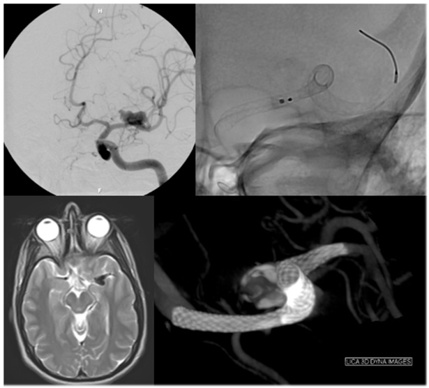 Brain Aneurysm