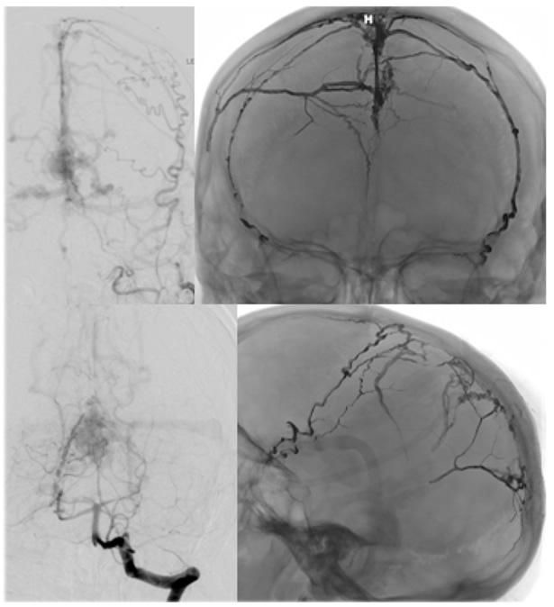 AV Fistula before and after treatment