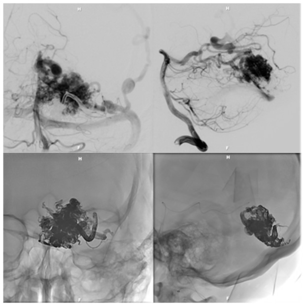 AVF before and after treatment