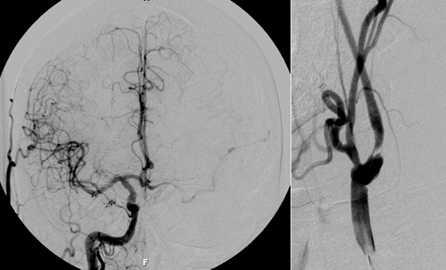 Carotid and Cerebral Angiogram