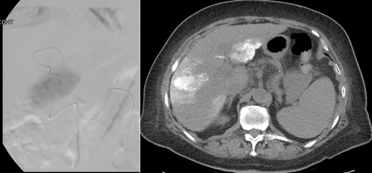 Chemoebolization Image