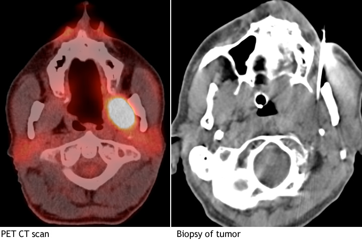 PET CT Scan of head with Biopsy of Tumor image