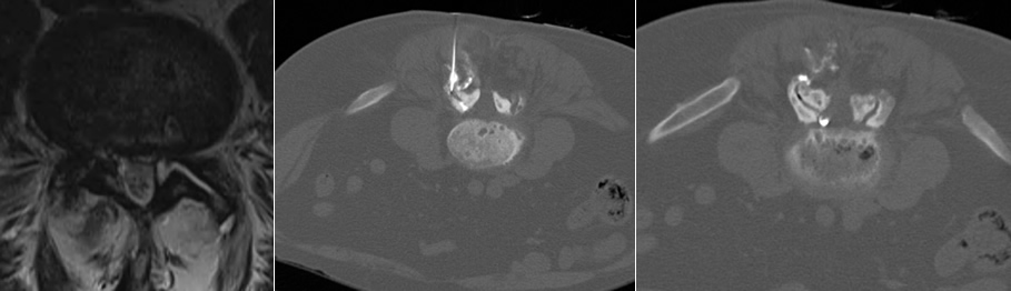 Cyst Injection and Rupture