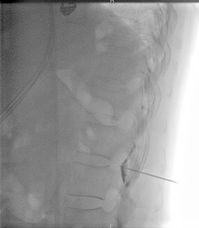 Epidural Blood Patch Placement Image