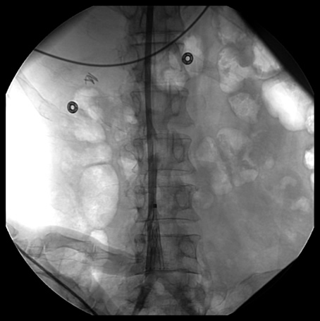 IVC Caval Filter Placement Image