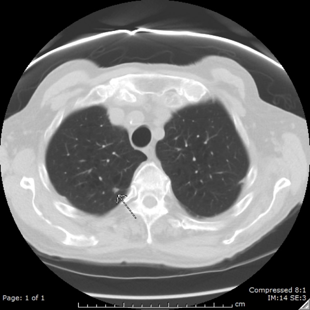 Lung Cancer Image