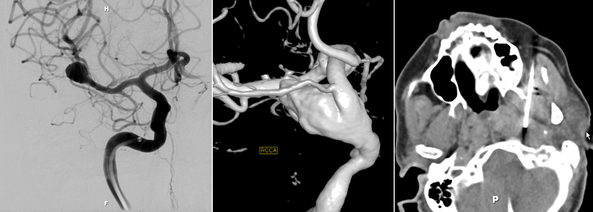 Neurointerventional Radiology Images