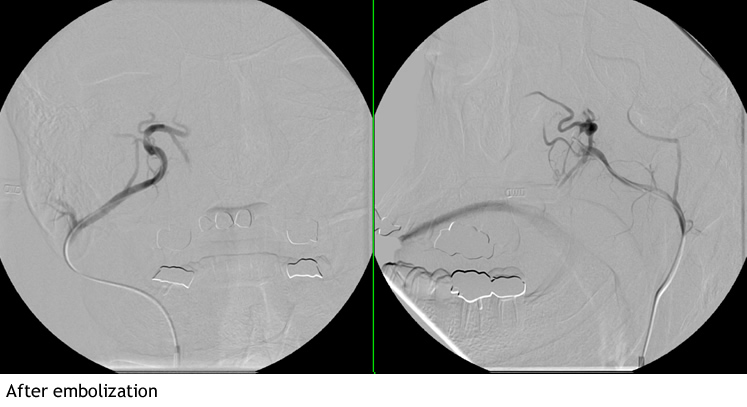 Nosebleed before and after embolization