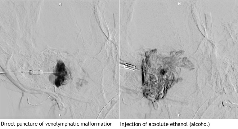 Sclerotherapy direct puncture and injection of malformation