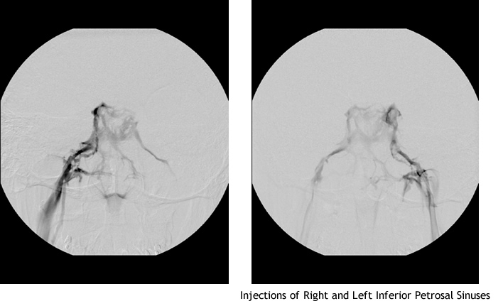 Inferior Petrosal Sinus Sampling