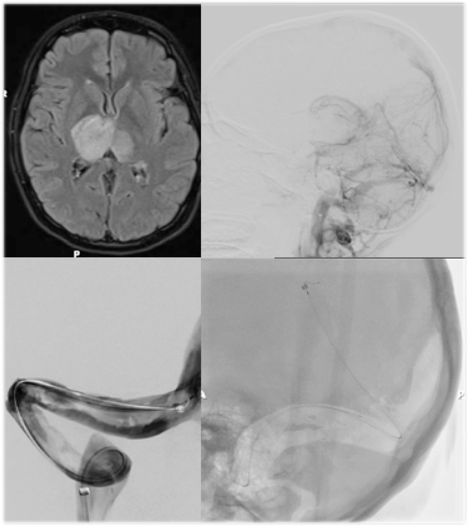 Cerebral Venous Sinus Thrombosis