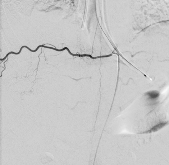 Spinal Angiography