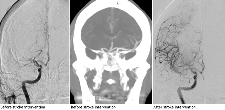 Stroke Intervention Before and After