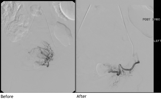 Uterine Fibroid Emobilzation Image