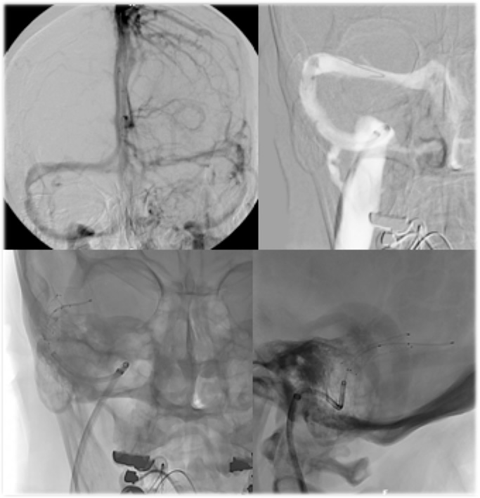 Venous Stenosis of the Brain