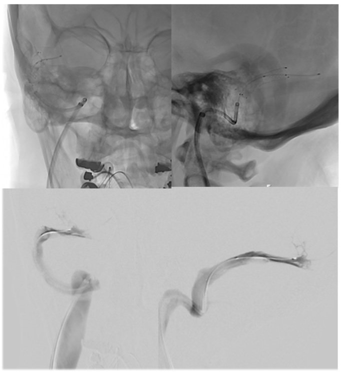 Venous Stenosis 